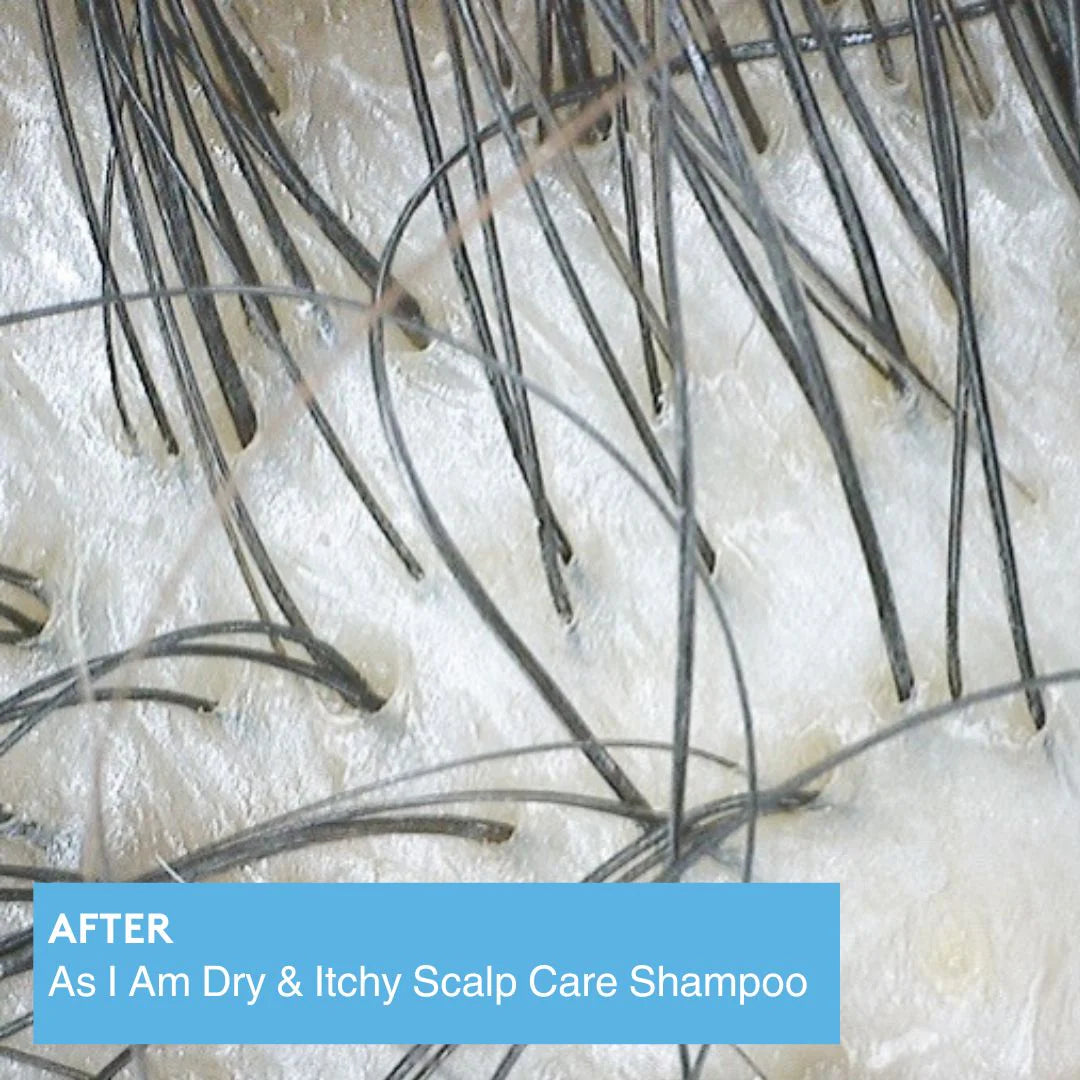 Close-up of hair with visible dandruff and text 'AFTER As I Am Dry & Itchy Scalp Care Shampoo' on a blue background